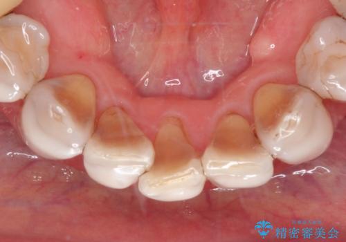 【オールセラミッククラウン】ダイレクトボンディングからのやりかえの治療前