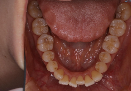 歯ぐき、骨が薄い方のマウスピース矯正治療　非抜歯でもIPR(歯を削る処置)で口元に変化をの治療前