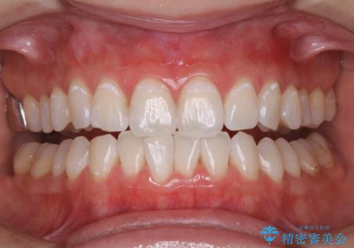 オフィスホワイトニングのエクセレントコースの治療後