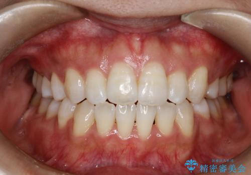 前歯がガタガタで咬めない　ワイヤーによる抜歯矯正で整った歯並びへの症例 治療後