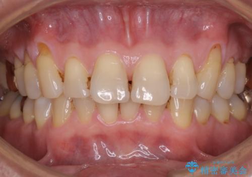 着色落とし希望(PMTC)の治療前