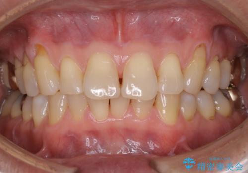 着色落とし希望(PMTC)の治療後