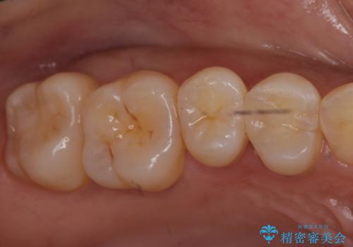 奥歯の虫歯　セラミックインレーで治療の症例 治療後