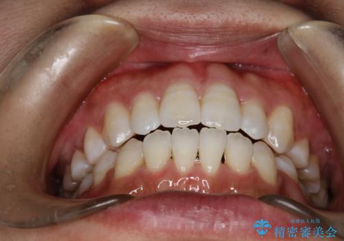 前歯がガタガタで咬めない　ワイヤーによる抜歯矯正で整った歯並びへの治療後