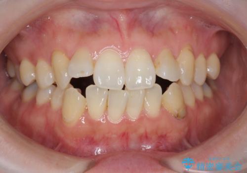 [ マウスピース矯正 ]  出っ歯を改善したいの症例 治療前