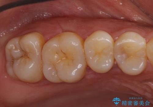 奥歯の虫歯　セラミックインレーで治療の症例 治療前
