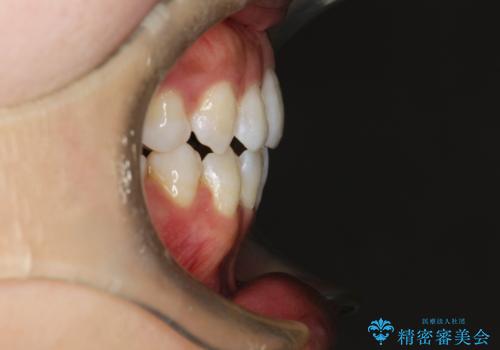 前歯がガタガタで咬めない ワイヤーによる抜歯矯正で整った歯並びへの治療後