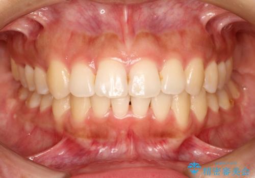 飛び出した前歯が気になる! 前歯のガタガタを抜歯をせずに治した症例の症例 治療後