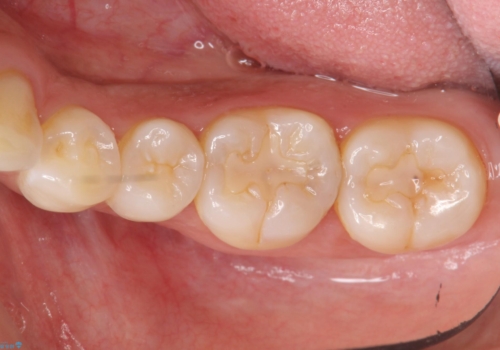 奥歯の虫歯　セラミックのつめものでやりかえの症例 治療前