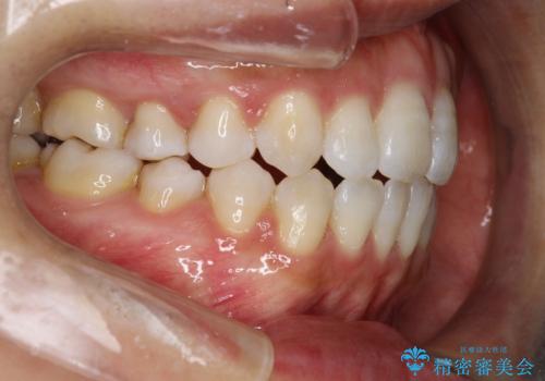 前歯がガタガタで咬めない ワイヤーによる抜歯矯正で整った歯並びへの治療後