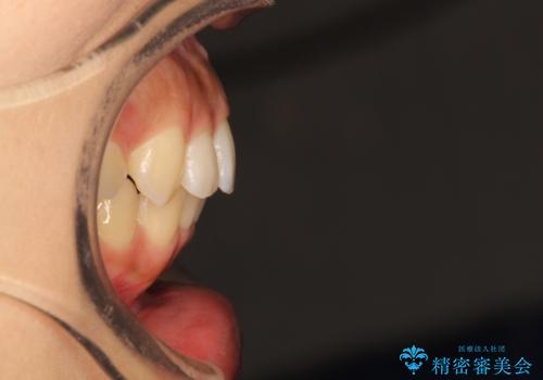 飛び出した前歯が気になる! 前歯のガタガタを抜歯をせずに治した症例の治療後