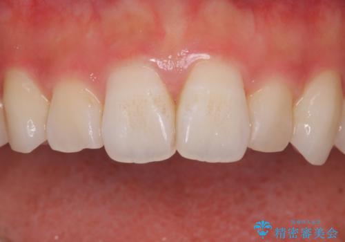 ホワイトニングスペシャルコースの治療前