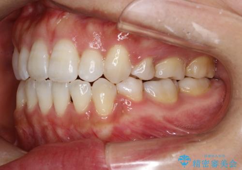 前歯がガタガタで咬めない ワイヤーによる抜歯矯正で整った歯並びへの治療後