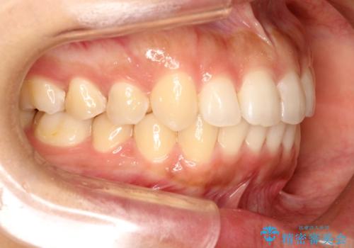 飛び出した前歯が気になる! 前歯のガタガタを抜歯をせずに治した症例の治療後