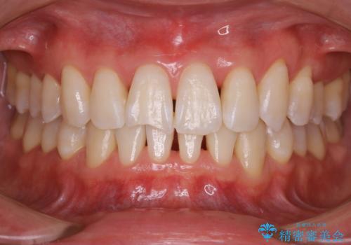 矯正後にホワイトニングの治療後