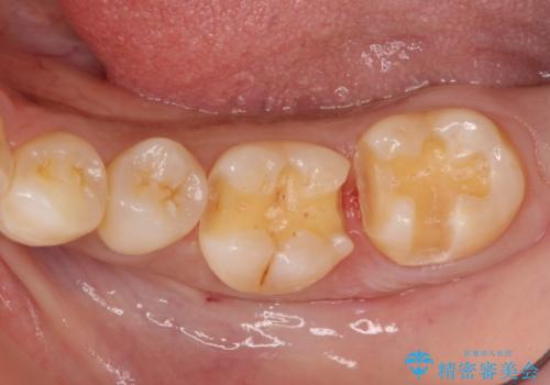 奥歯の虫歯 セラミックのつめものでやりかえの治療中