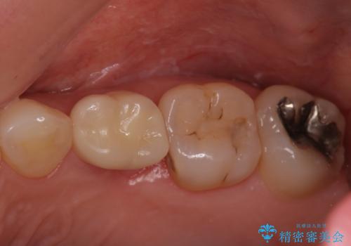 銀歯と歯の形が気になる　セラミックの症例 治療後