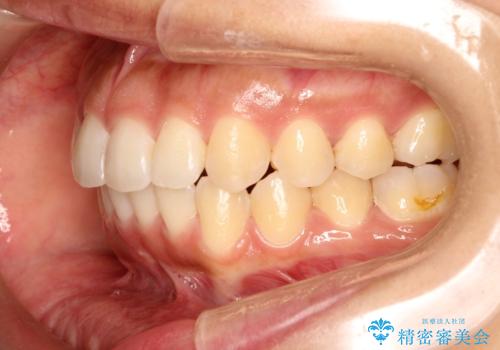 飛び出した前歯が気になる! 前歯のガタガタを抜歯をせずに治した症例の治療後