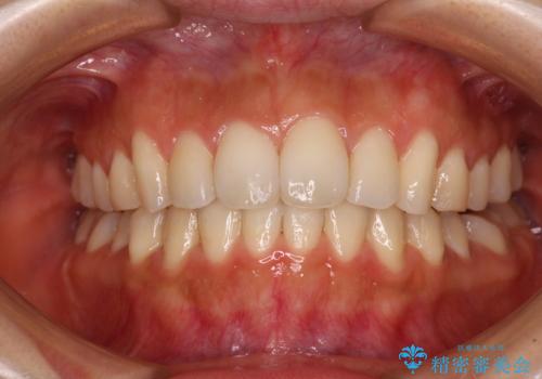 カリエールディスタライザーを併用した、咬み合わせ改善のインビザライン矯正の治療中