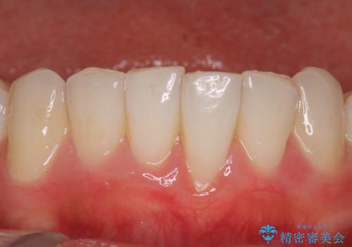 ホワイトニングスペシャルコースの治療前