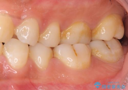 奥歯の虫歯 セラミックのつめものでやりかえの治療前