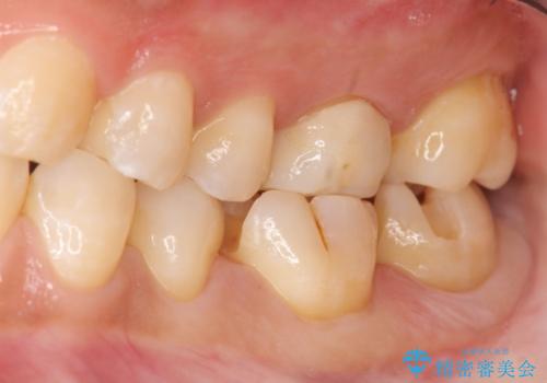 奥歯の虫歯 セラミックのつめものでやりかえの治療中