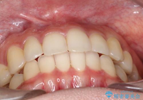 前歯のがたがた気になる インビザラインによる矯正治療の治療後