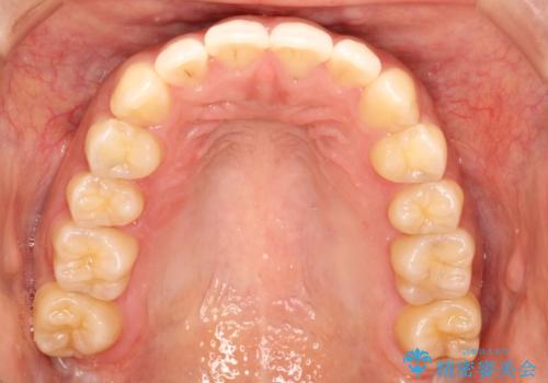 飛び出した前歯が気になる! 前歯のガタガタを抜歯をせずに治した症例の治療後