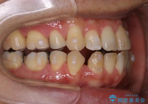 再矯正症例 前歯のガタガタと噛み合わせのズレをマウスピースで治した症例の治療中