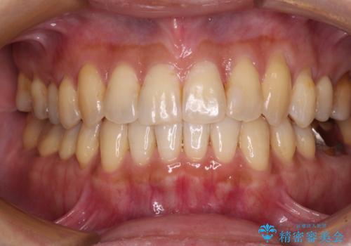 リスク回避 ワイヤー矯正を併用したインビザライン矯正治療の治療後