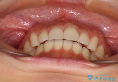 カリエールディスタライザーを併用した、咬み合わせ改善のインビザライン矯正の治療中