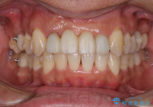 着色落とし(PMTC30分)の治療後