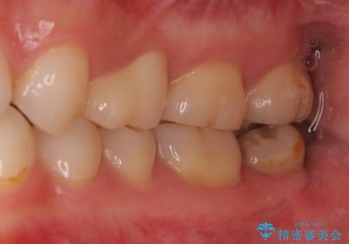 銀歯と歯の形が気になる　セラミックの治療後