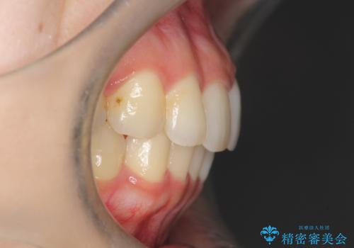前歯のがたがた気になる　インビザラインによる矯正治療の治療後