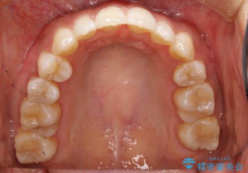 前歯がガタガタで咬めない ワイヤーによる抜歯矯正で整った歯並びへの治療後