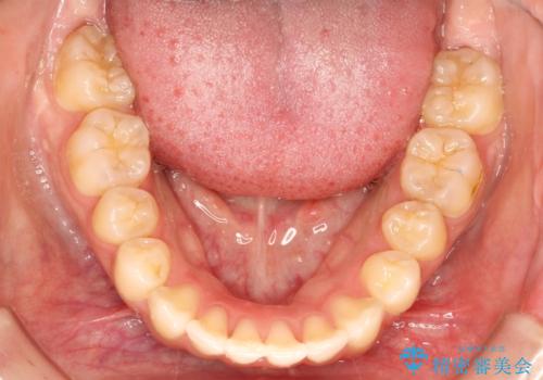 飛び出した前歯が気になる! 前歯のガタガタを抜歯をせずに治した症例の治療後