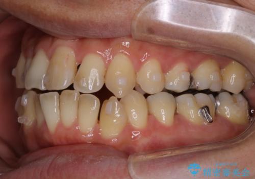 再矯正症例 前歯のガタガタと噛み合わせのズレをマウスピースで治した症例の治療中