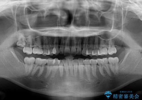 【モニター】前歯のデコボコを目立たないワイヤー装置で短期間矯正治療の治療前
