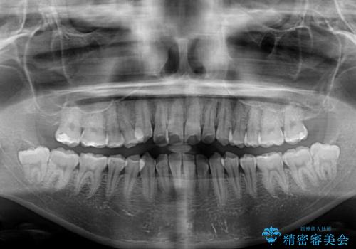 【モニター】前歯の前突感とクロスバイトをインビザラインで改善の治療前
