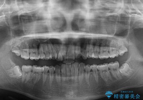 インビザラインが続けられない ワイヤー矯正での抜歯矯正 その2の治療前