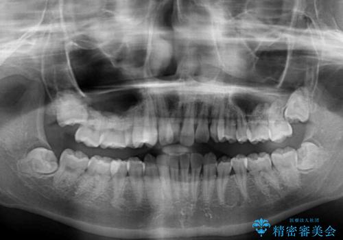 上顎のみの抜歯矯正 前歯のデコボコを改善するの治療前