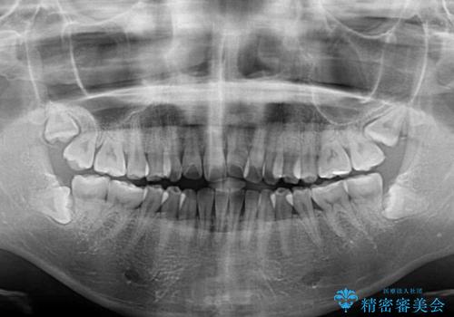 カリエールディスタライザーを併用した、咬み合わせ改善のインビザライン矯正の治療前