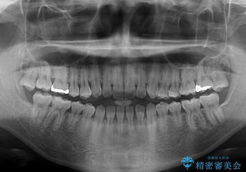 舌突出癖で口元が開いてしまう 舌トレーニングを行ったインビザライン矯正の治療前