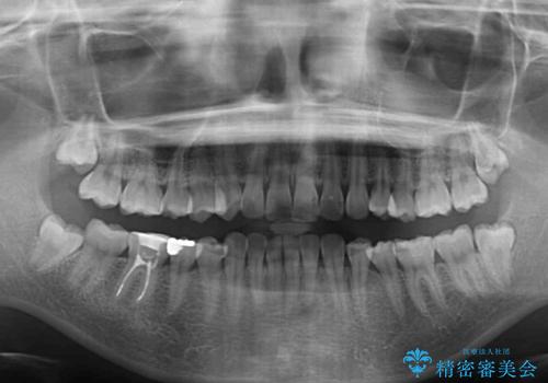 前歯の突出感とデコボコをインビザライン矯正で改善の治療前