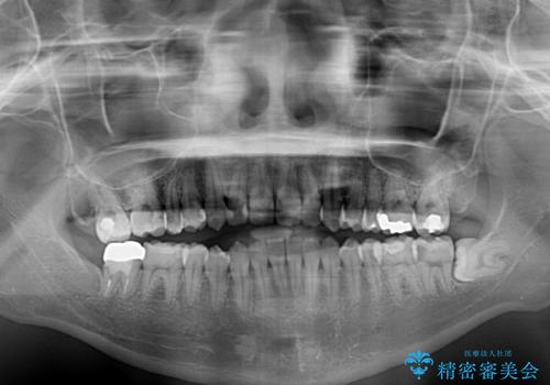 オープンバイトによる見た目を治したい インビザラインでの矯正治療の治療前