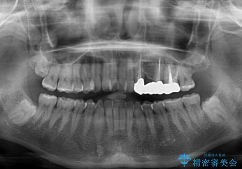 捻れた前歯と銀歯のブリッジを治したい ワイヤー矯正とオールセラミックブリッジの治療前