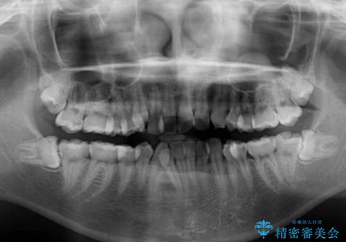 インビザラインが続けられない　ワイヤー矯正での抜歯矯正　その1の治療前
