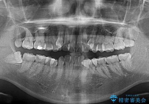 【モニター】八重歯を抜歯矯正でスッキリした口元にの治療前