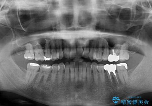 リスク回避 ワイヤー矯正を併用したインビザライン矯正治療の治療前