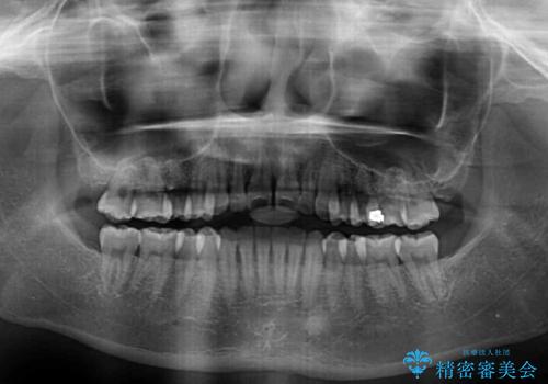 すきっ歯とオープンバイトをインビザラインで改善の治療前